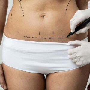 Liposuction Nedir?